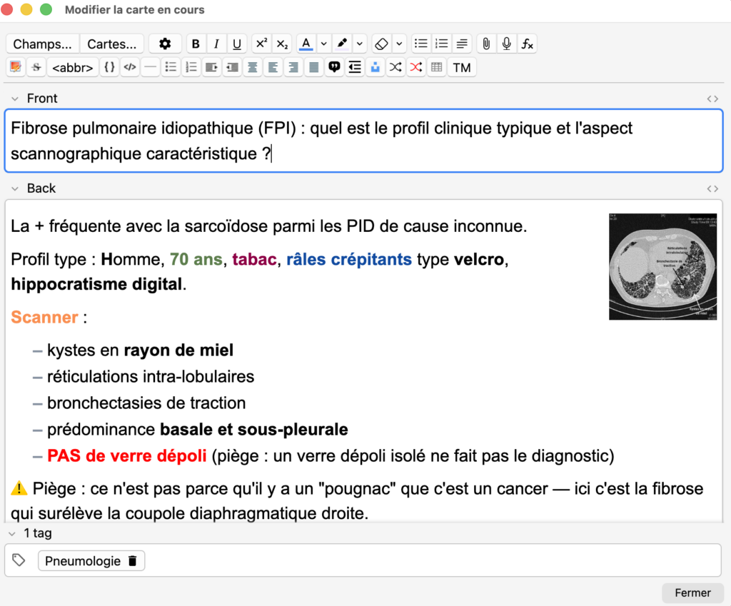 Exemple de carte Anki en cours d’édition : profil clinique et aspect scannographique de la fibrose pulmonaire idiopathique