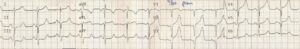 Tracé ECG — Cas 5