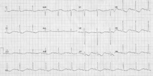 Tracé ECG — Cas 6