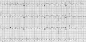 Tracé ECG — Cas 7