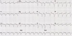 Tracé ECG — Cas 8