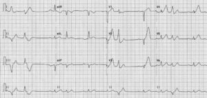 Tracé ECG — Cas 9