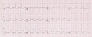 Tracé ECG — Cas 1
