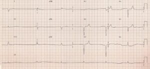 Tracé ECG — Cas 3