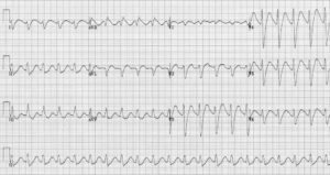 Tracé ECG — Cas 4
