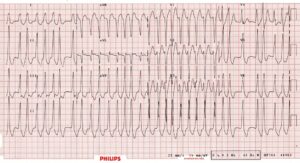 Tracé ECG — Cas 2
